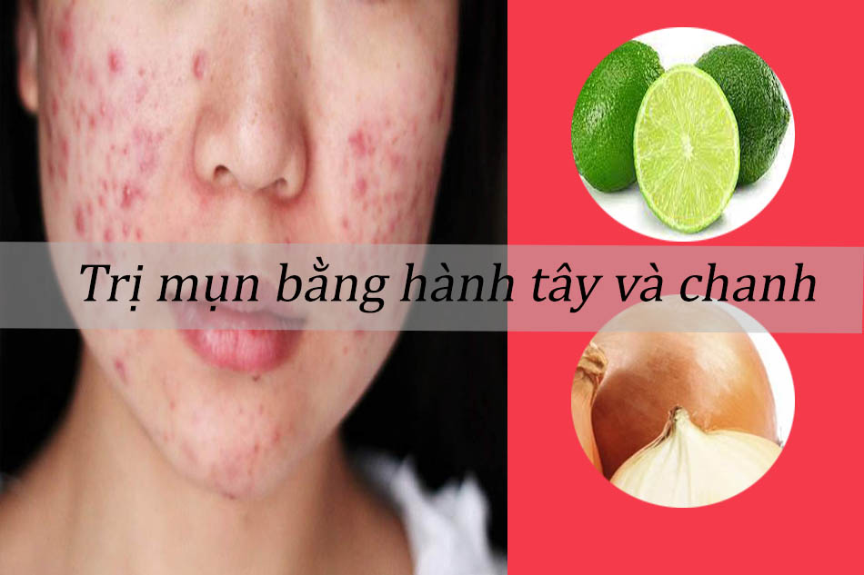 Cách trị mụn thâm, mụn ẩn dưới da bằng hành tây và nước cốt chanh