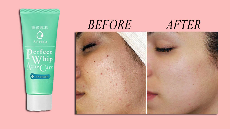 Sữa rửa mặt trị mụn Senka Perfect Whip Acne Care